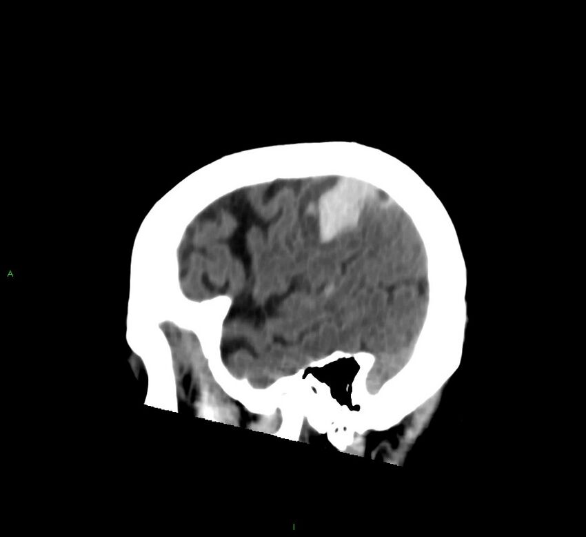 Cerebral amyloid angiopathy-associated lobar intracerebral hemorrhage (Radiopaedia 58376-65513 C 21).jpg