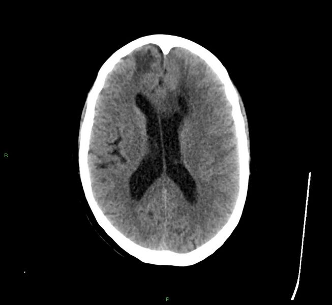 File:Cerebral amyloid angiopathy-associated lobar intracerebral hemorrhage (Radiopaedia 58529-65681 Axial non-contrast 23).jpg