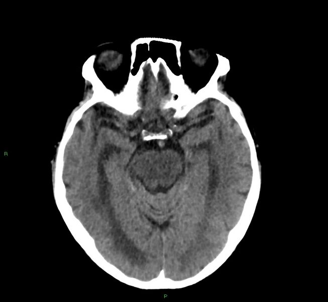 File:Cerebral amyloid angiopathy-associated lobar intracerebral hemorrhage (Radiopaedia 58530-65688 Axial non-contrast 32).jpg