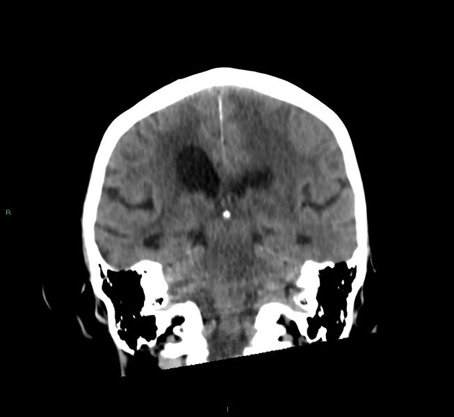 File:Cerebral amyloid angiopathy-associated lobar intracerebral hemorrhage (Radiopaedia 58530-65688 Coronal non-contrast 30).jpg