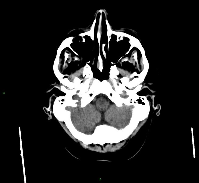 File:Cerebral amyloid angiopathy-associated lobar intracerebral hemorrhage (Radiopaedia 58560-65723 Axial non-contrast 45).jpg