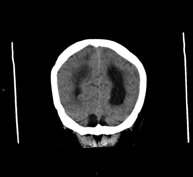 File:Cerebral amyloid angiopathy-associated lobar intracerebral hemorrhage (Radiopaedia 58560-65723 Coronal non-contrast 16).jpg