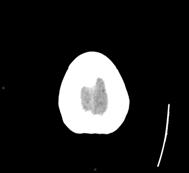File:Cerebral amyloid angiopathy-associated lobar intracerebral hemorrhage (Radiopaedia 58563-65727 Axial non-contrast 8).jpg