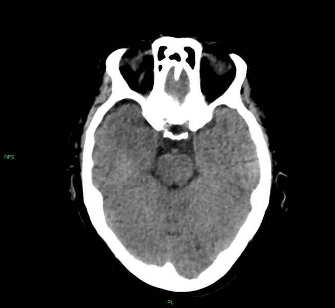 File:Cerebral amyloid angiopathy-associated lobar intracerebral hemorrhage (Radiopaedia 58569-65734 Axial non-contrast 41).jpg