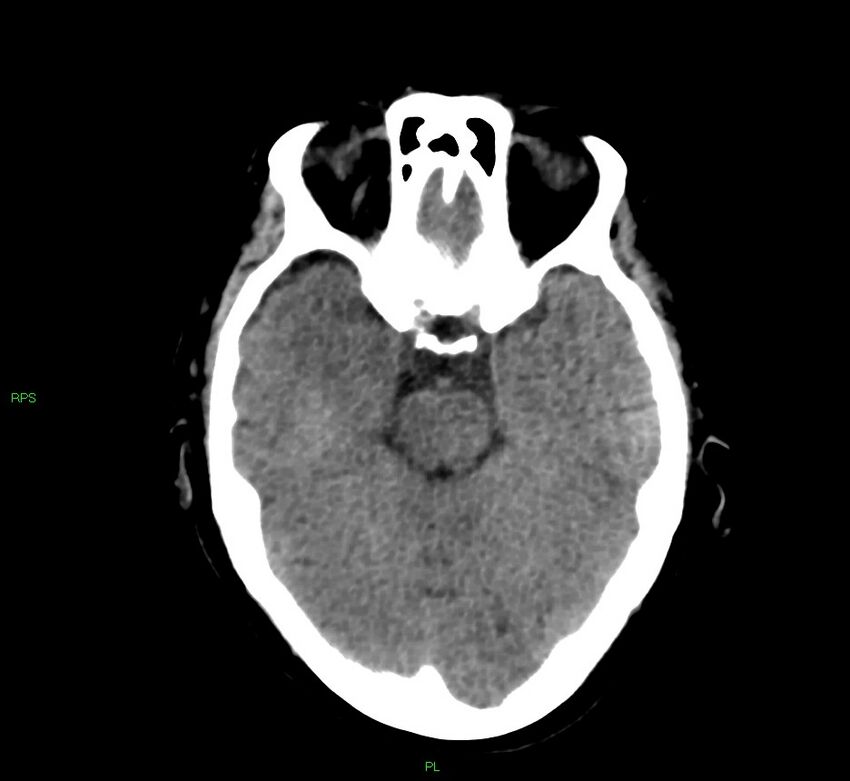 Cerebral amyloid angiopathy-associated lobar intracerebral hemorrhage (Radiopaedia 58569-65734 Axial non-contrast 41).jpg