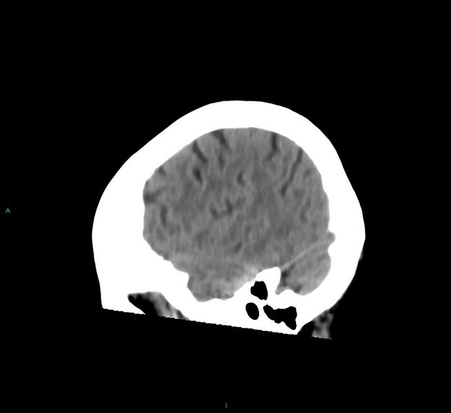 File:Cerebral amyloid angiopathy-associated lobar intracerebral hemorrhage (Radiopaedia 58754-65975 C 9).jpg