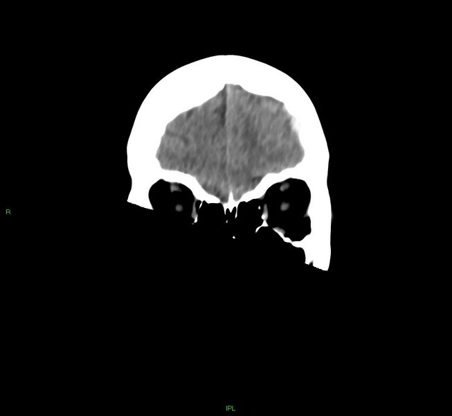 File:Cerebral amyloid angiopathy-associated lobar intracerebral hemorrhage (Radiopaedia 58754-65975 Coronal non-contrast 51).jpg
