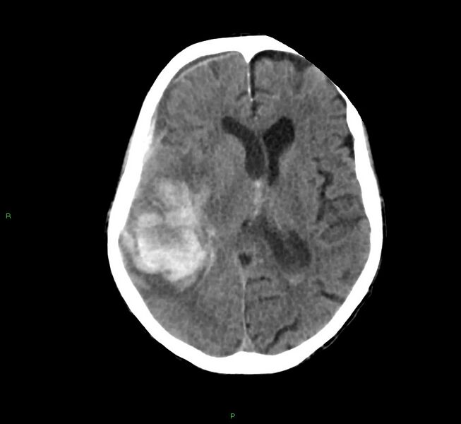 File:Cerebral amyloid angiopathy-associated lobar intracerebral hemorrhage (Radiopaedia 58758-65980 Axial non-contrast 24).jpg