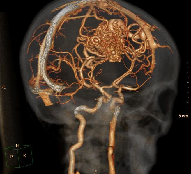 File:Cerebral arteriovenous malformation (Radiopaedia 29531-30031 C 7).jpg