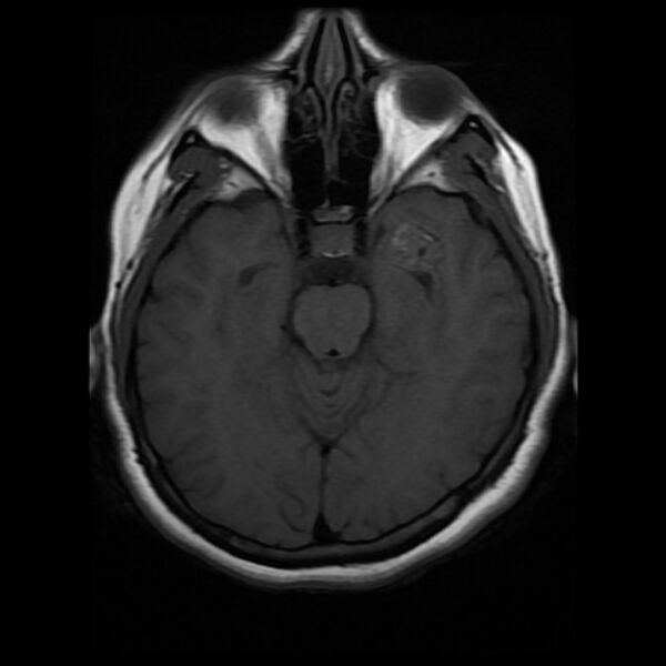 File:Cerebral cavernous malformation (Radiopaedia 44301-47942 Axial T1 8).jpg