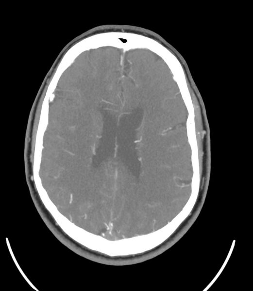 File:Cerebral dural venous sinus thrombosis (Radiopaedia 86514-102576 A 65).jpg
