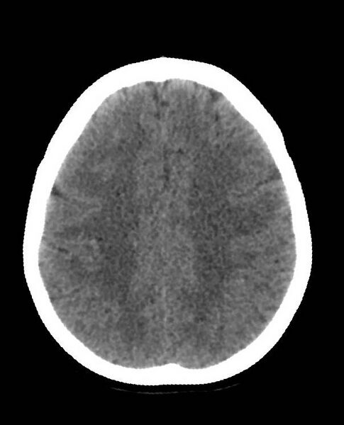 File:Cerebral edema due to severe hyponatremia (Radiopaedia 89826-106938 Axial non-contrast 74).jpg