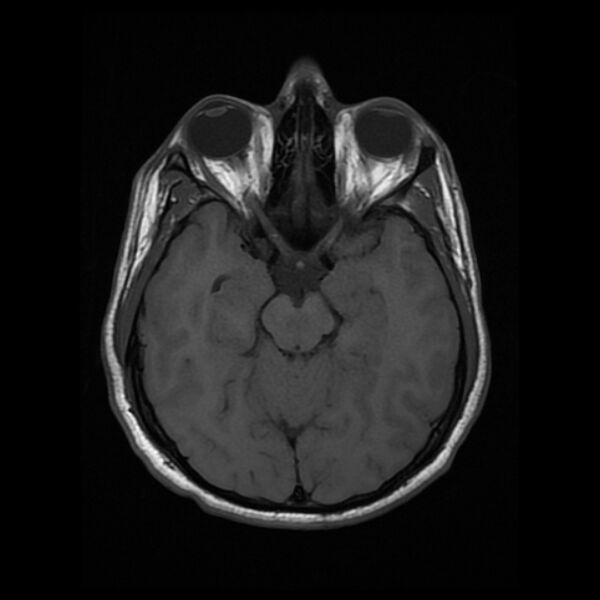 File:Cerebral fat embolism (Radiopaedia 37510-39363 Axial T1 11).jpg