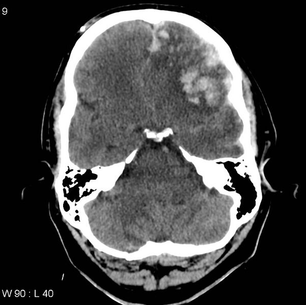 File:Cerebral hemorrhagic contusion with subdural and subarachnoid hemorrhage (Radiopaedia 10680-19197 Axial non-contrast 5).jpg