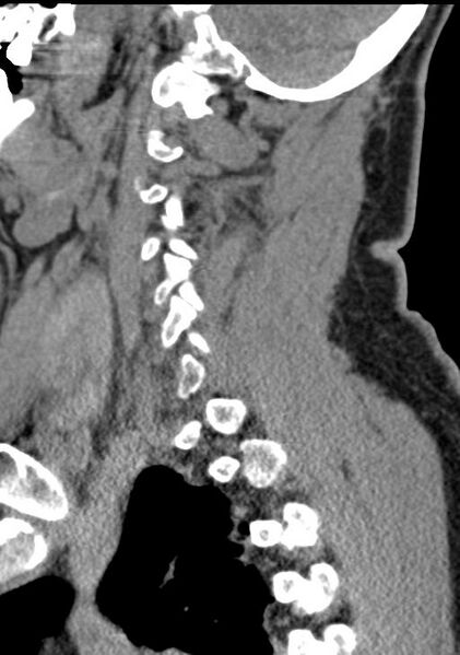 File:Cerebral hemorrhagic contusions and cervical spine fractures (Radiopaedia 32865-33841 G 77).jpg
