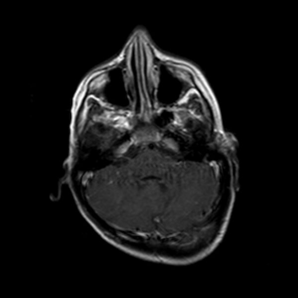 File:Cerebral tuberculoma (Radiopaedia 41152-43932 Axial T1 C+ 5).jpg