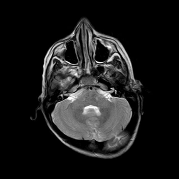 File:Cerebral tuberculoma (Radiopaedia 41152-43932 Axial T2 5).jpg