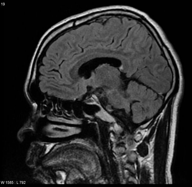 File:Cerebral vasculitis (Radiopaedia 5131-6923 Sagittal FLAIR 6).jpg
