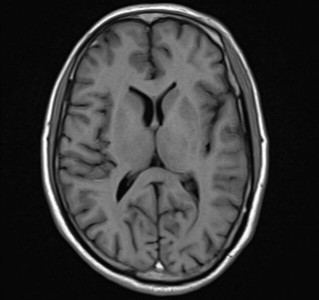 File:Cerebral venous thrombosis (Radiopaedia 71207-81504 Axial T1 14).jpg