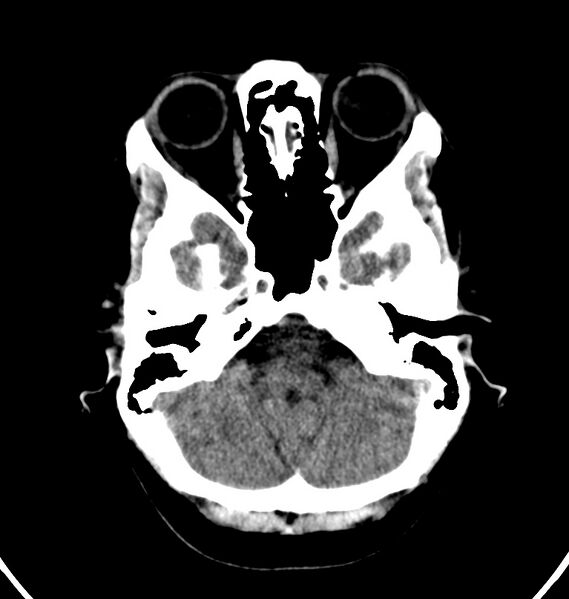 File:Cerebral venous thrombosis - CT only (Radiopaedia 41031-43778 Axial non-contrast 70).jpg