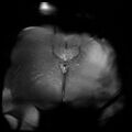 Cervical carcinoma (Radiopaedia 78847-91705 Coronal T2 fat sat 16).jpg