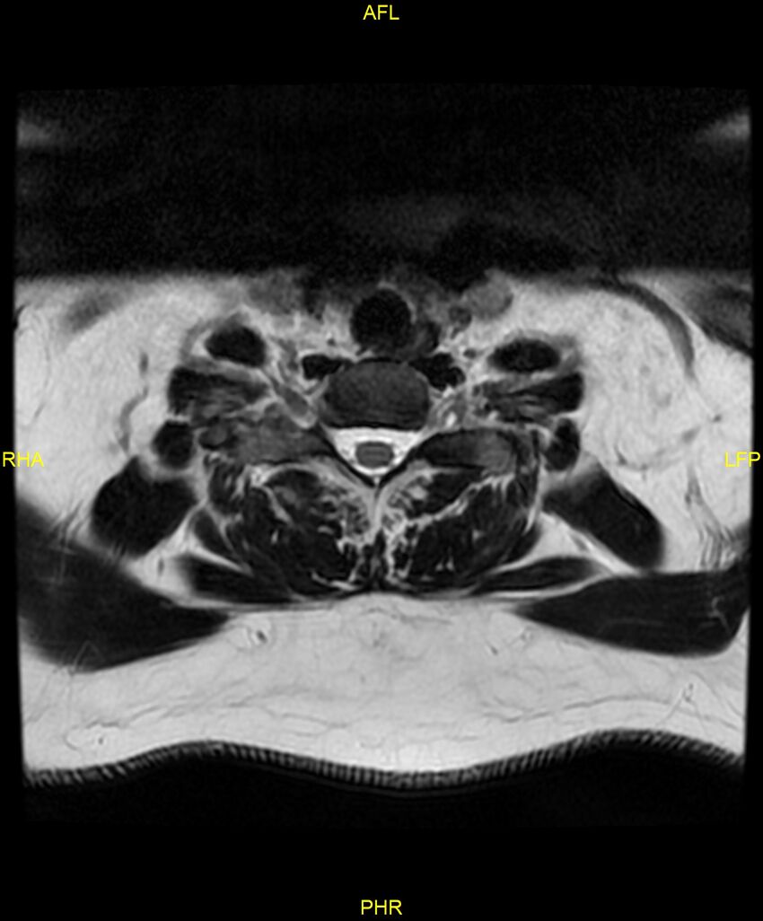 Cervical disc protrusion (Radiopaedia 87147-103415 Axial T2 67).jpg