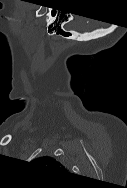 File:Cervical spine ACDF loosening (Radiopaedia 48998-54070 Sagittal bone window 9).png