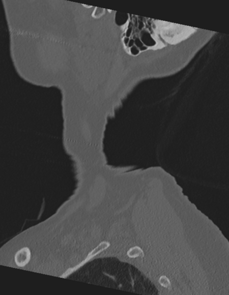 File:Cervical spine ACDF loosening (Radiopaedia 48998-54071 Sagittal bone window 7).png