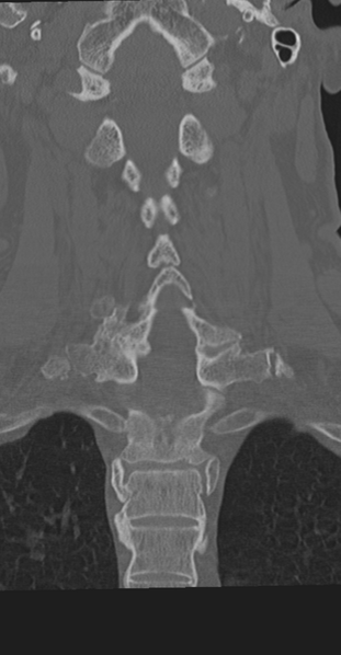 File:Cervical spine fracture in the setting of ankylosis (Radiopaedia 37038-38715 Coronal bone window 41).png