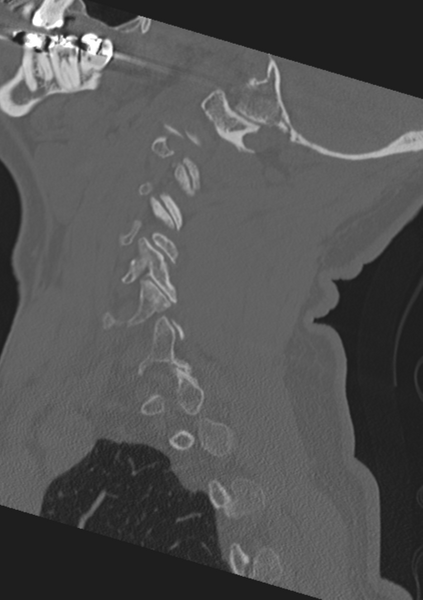 File:Cervical spine fractures with vertebral artery dissection (Radiopaedia 53296-59268 Sagittal bone window 52).png