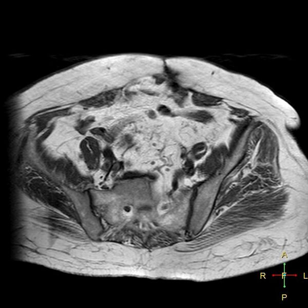 File:Cervical stump squamous cell carcinoma (Radiopaedia 48049-52858 Axial T1 16).jpg