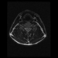 Cervical vertebrae metastasis (Radiopaedia 78814-91667 Axial T2 9).png