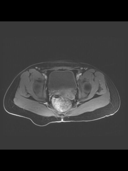 File:Cesarean section scar endometrioma (Radiopaedia 56569-63297 Axial T1 C+ fat sat 13).jpg