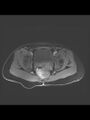 Cesarean section scar endometrioma (Radiopaedia 56569-63297 Axial T1 C+ fat sat 13).jpg