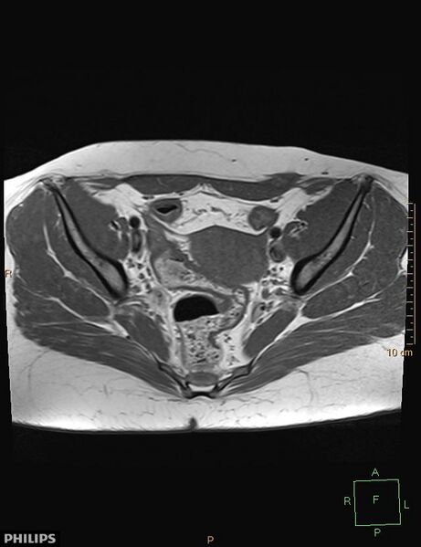 File:Cesarian scar endometriosis (Radiopaedia 68495-78066 Axial T1 10).jpg