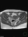 Cesarian scar endometriosis (Radiopaedia 68495-78066 Axial T1 10).jpg