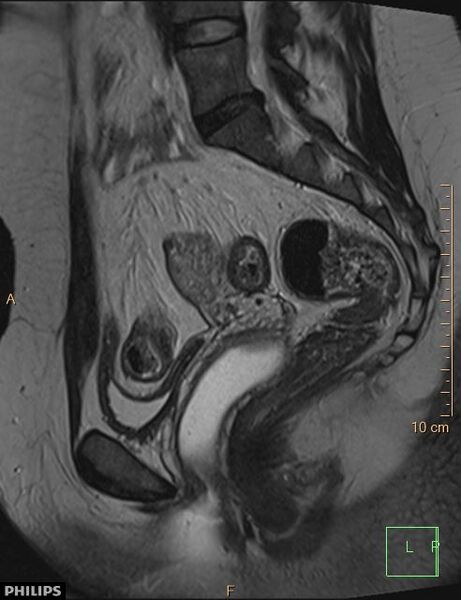 File:Cesarian scar endometriosis (Radiopaedia 68495-78066 Sagittal T2 12).jpg