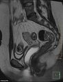 Cesarian scar endometriosis (Radiopaedia 68495-78066 Sagittal T2 12).jpg
