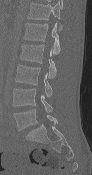 File:Chance fracture (Radiopaedia 40360-42912 Sagittal bone window 45).png