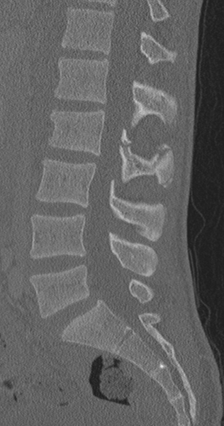 File:Chance fracture (Radiopaedia 40360-42912 Sagittal bone window 53).png