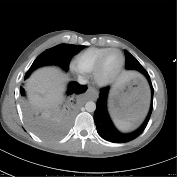 File:Chest and abdomen multi-trauma (Radiopaedia 26294-26426 bone window 10).jpg