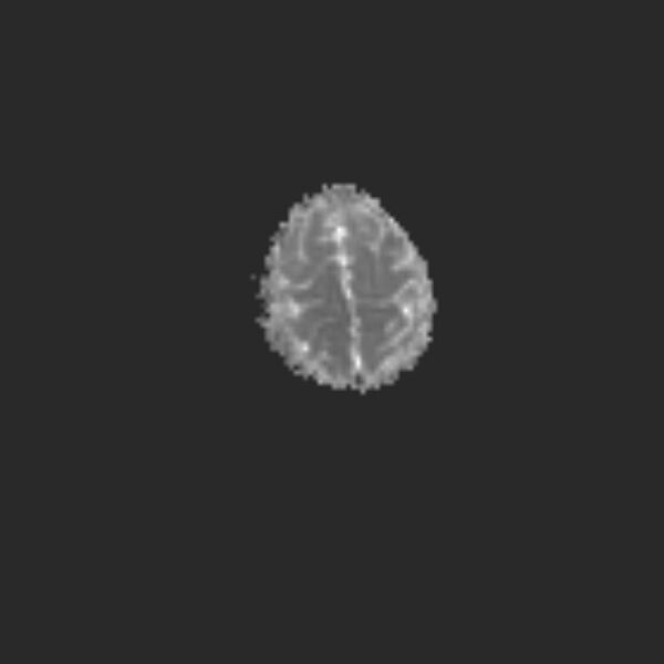 File:Chiari III malformation with occipital encephalocele (Radiopaedia 79446-92559 Axial ADC 20).jpg