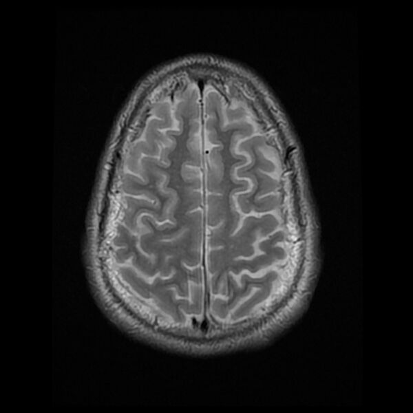 File:Chiasmatic-hypothalamic juvenile pilocytic astrocytoma (Radiopaedia 78533-91235 Axial T2 23).jpg
