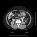 Choledochal cyst with chronic calcific pancreatitis (Radiopaedia 18245-18061 A 19).png
