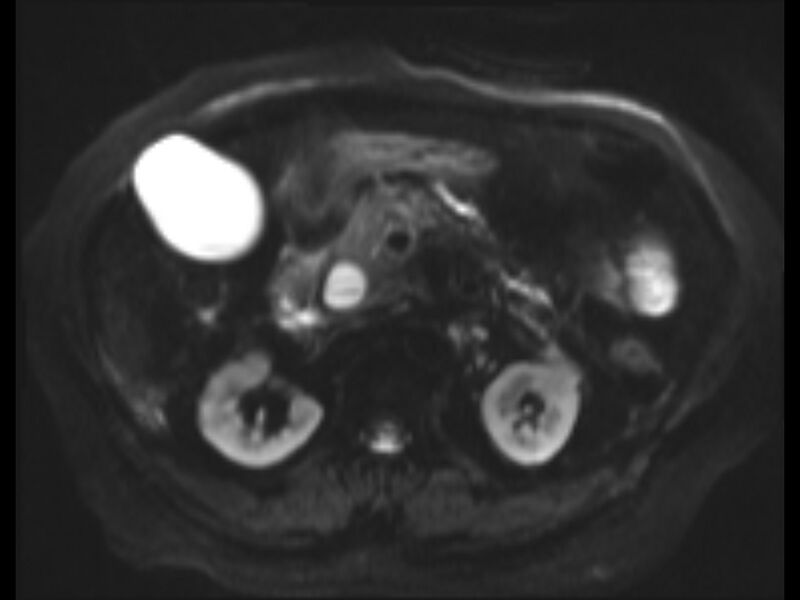 File:Choledocholithiasis causing intrahepatic biliary duct dilation (Radiopaedia 39908-42369 Axial T2 SPAIR 12).jpg