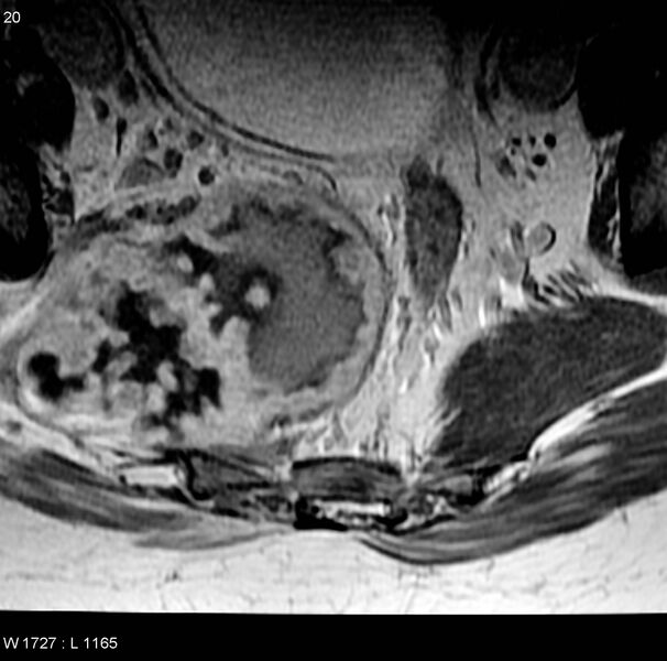 File:Chondrosarcoma - sacrum (Radiopaedia 6173-7627 Axial T1 C+ 7).jpg