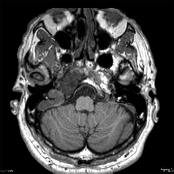 File:Chondrosarcoma of skull base- grade II (Radiopaedia 40948-43654 Axial T1 19).jpg