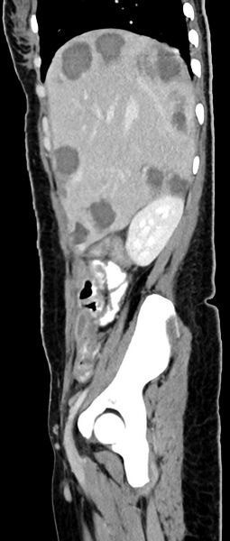 File:Choriocarcinoma liver metastases (Radiopaedia 74768-85766 C 130).jpg