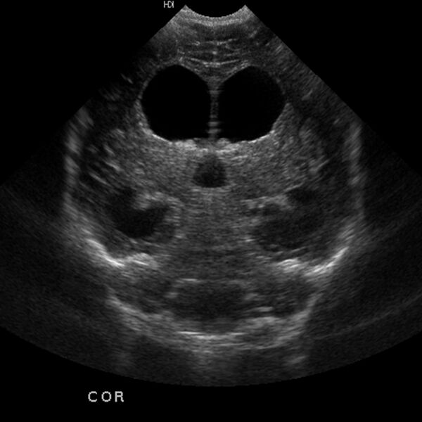 File:Choroid plexus carcinoma (Radiopaedia 21121-21033 A 3).jpg