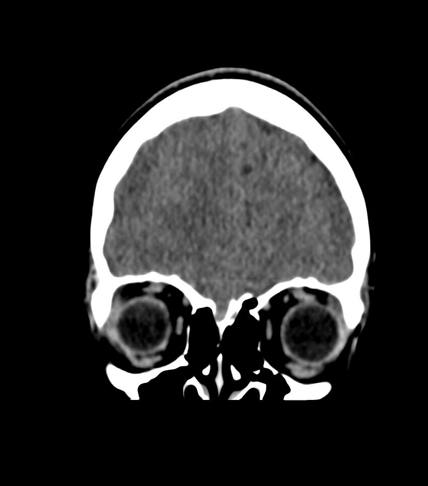 Choroid plexus carcinoma (Radiopaedia 91013-108552 Coronal non-contrast 16).jpg